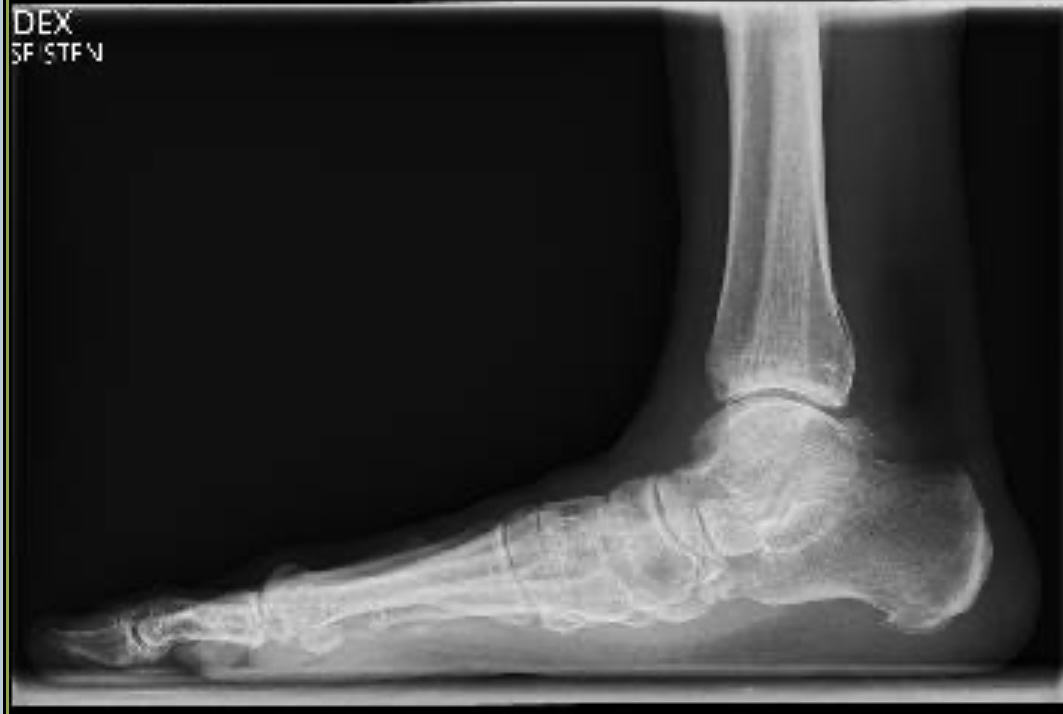 Toipuminen lattajalkaleikkauksesta